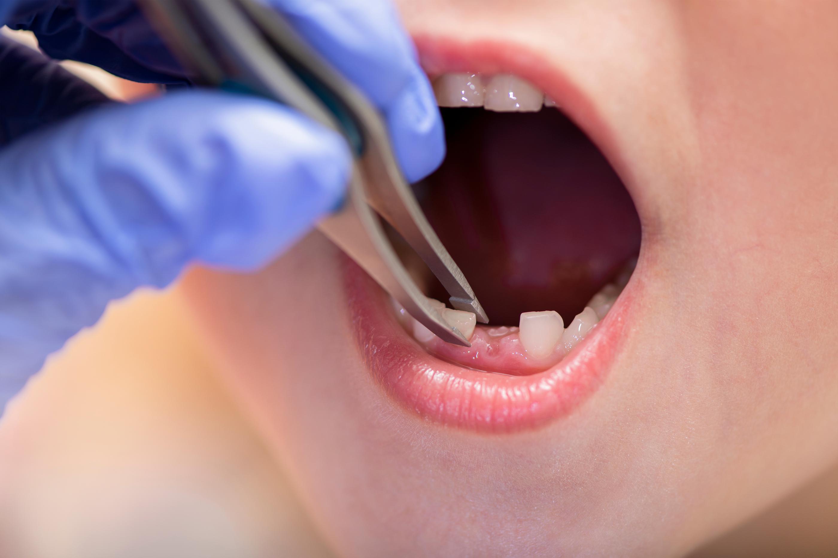 Pediatric Tooth Extraction Fairfax, VA